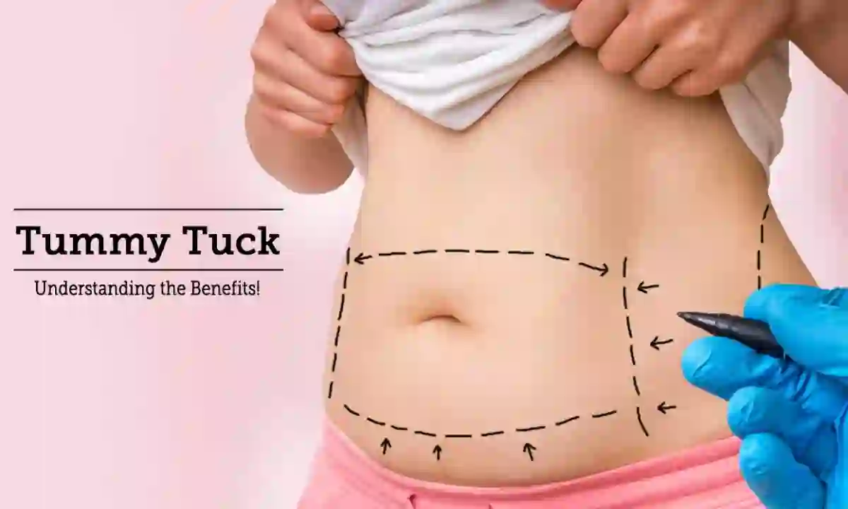 How to get a tummy tuck for free